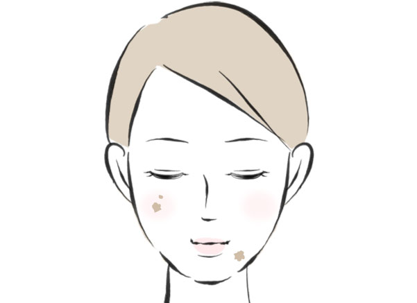 色素沈着のシミのイラスト